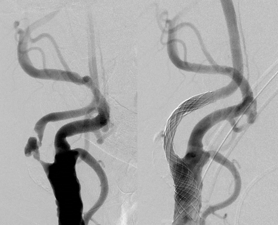 Hochgradige Verengung der Halsschlagader vor und nach Stent-Behandlung